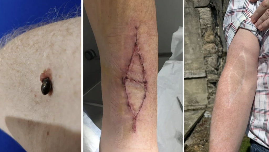 Farmer Dismissed Symptom As a Bite. It Was Stage 4 Melanoma